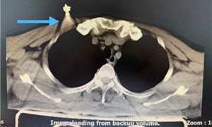 胸骨碎裂直刺心脏边缘！创新术式破解危重胸骨骨折难题